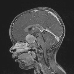 Pilozystisches Astrozytom des Chiasma und Hypothalamus bei einem Kind, Quelle: © dkg-web.de