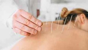 Akupunktur Frau