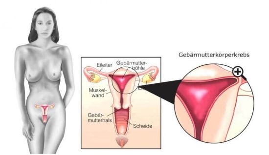Gebärmutterkörper, Quelle: © Henrie - fotolia.com
