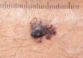 Schwarzer Hautkrebs - oberflächlich spreitendes Melanom 2