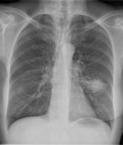 Röntgenbild eines Patienten mit Lungenkarzinom im linken Oberlappen. Quelle: PD Dr. Martin Reck