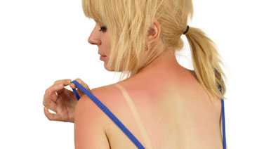 Hautkrebs: So können Sie sich schützen - Sonnenbrand vermeiden
