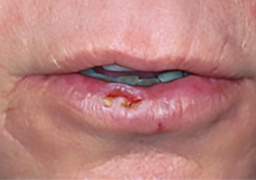 Plattenepithelkarzinom an der Lippe