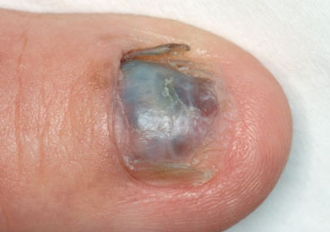 Schwarzer Hautkrebs - Melanom unter Fingernagel