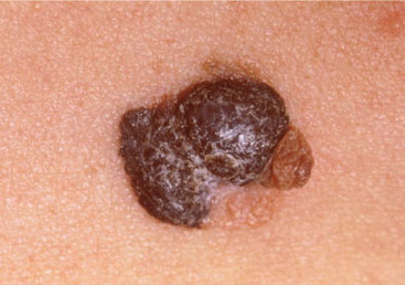 Schwarzer Hautkrebs - noduläres (knotiges) Melanom